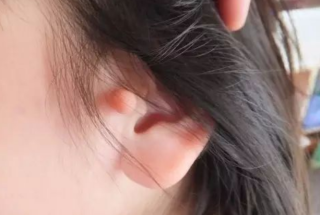 附耳切除术前注意事项有哪些，疤痕明显吗？