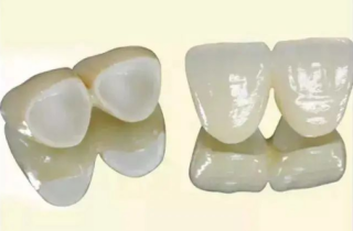 常用的全瓷牙有哪些，适应症有哪些？