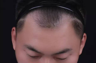 头发种植术后脱落期会持续多久，做完后多久洗头？