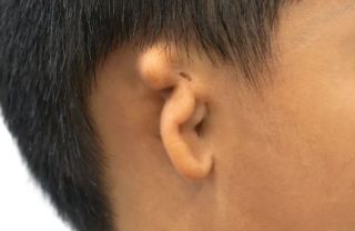 小耳畸形矫正手术方式的最佳年龄是几岁，优缺点是什么？