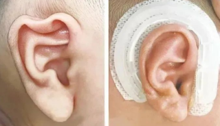 杯状耳矫正耳模佩戴需要多长时间，会不舒服吗？