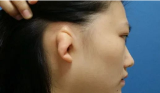 小耳畸形矫正多大适合做，如何治疗？