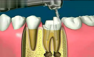 根管治疗疼不疼，术后牙齿能用多久？