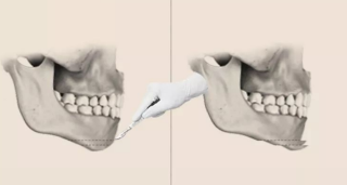 下巴截骨术有几种方式，有哪些手术注意事项？