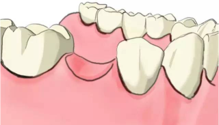 为什么牙缺失后一定要镶牙，为什么不能医保报销？