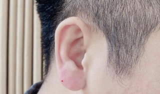 耳垂矫正适应症有哪些，会留疤吗？