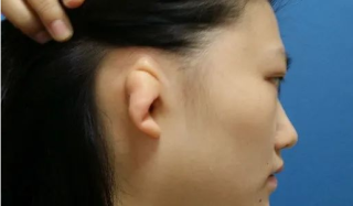 小耳畸形矫正一般需要多少钱，手术期间有什么注意事项？