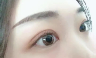 韩式定点双眼皮有什么优缺点，术后不能吃什么？
