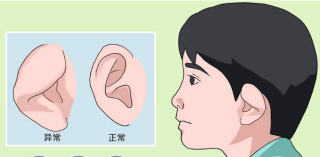 杯状耳矫正的效果如何，手术难度大吗？