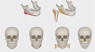 磨下颌角适应人群有哪些，术前注意事项有哪些？