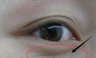 激光去眼袋能维持多久，术后为什么一直淤青？