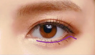 外切法去眼袋可能有哪些并发症，会留疤吗？