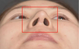 鼻中隔软骨隆鼻的后遗症有哪些，取软骨会留疤痕吗？