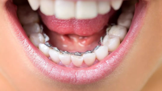 舌侧矫正的材料有哪些，青少年适合做吗？