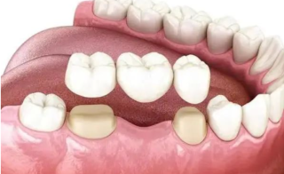 为什么镶牙前要先洗牙，镶一颗坏三颗是真的吗？