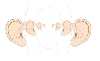 小耳畸形矫正该怎么治疗，都要手术吗？