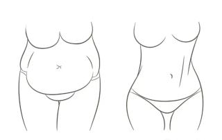 哪些情况适合做腹壁成形术，手术的过程是怎样的？