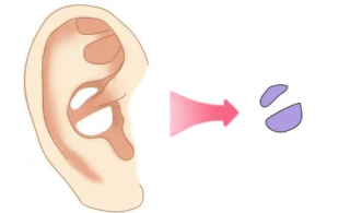 自体耳软骨隆鼻优缺点是什么，取软骨耳朵会变形吗？