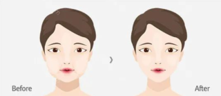 去颊脂垫瘦脸效果怎么样，有什么副作用？