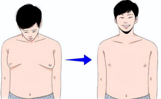 男性乳房肥大矫正适应症有哪些，怎么治疗？