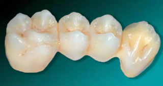 哪些牙齿情况适宜全瓷牙修复，影响冠裂的因素有哪些？