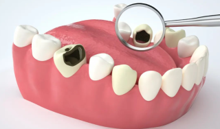 补牙的操作步骤有几个阶段，牙痛如何处理？