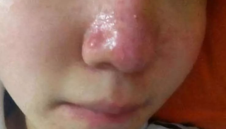 激光治疗酒糟鼻有疤痕吗，副作用是什么？