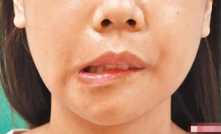 矫正歪下巴有哪些方式，不矫正有什么危害？