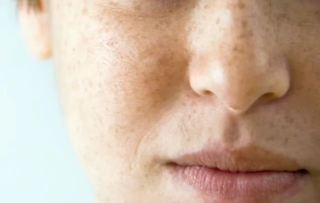 CO2点阵激光对哪些皮肤病有效果，会不会使皮肤越做越薄？