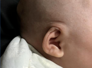 杯状耳矫正手术重点是什么，术后会影响孩子后期的听力吗？