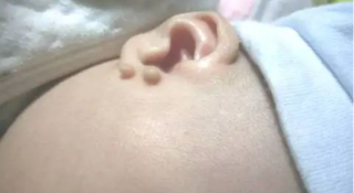 附耳切除会影响到正常的听力吗，术前准备有哪些？