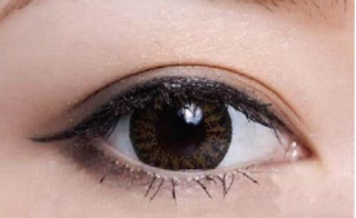埋线法双眼皮有哪些优势，后遗症是什么？