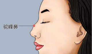 驼峰鼻矫正多久可以恢复，手术要注意什么？