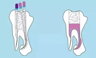 牙齿出现哪些情况需根管治疗，局限性有哪些？