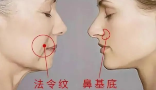 假体垫鼻基底是怎么做到的，适应人群有哪些？
