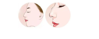 驼峰鼻的矫正原理是什么，矫正方法是什么？