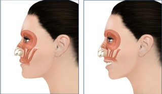 鹰钩鼻矫正方法有哪些，矫正术的过程是什么？